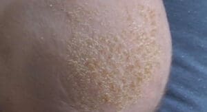 cradle-cap