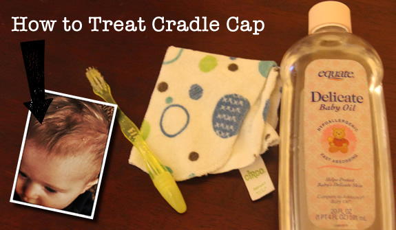 Get rid of Cradle Cap! how to treat cradle cap