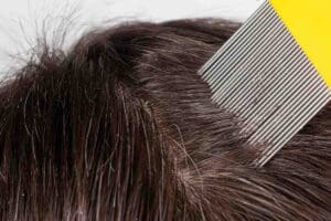 head lice