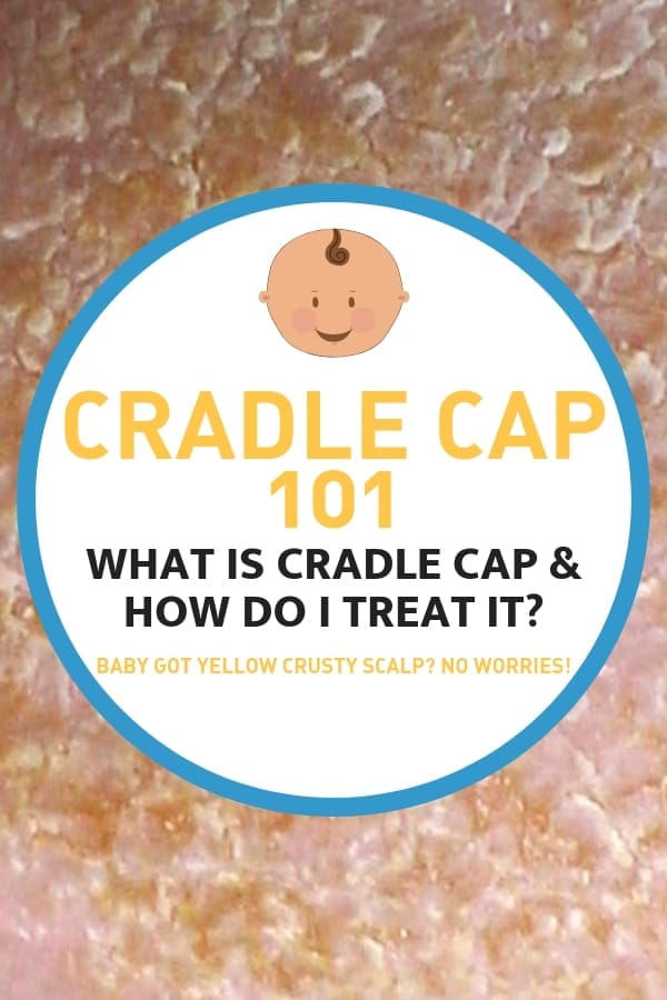 cradlecaptreatment